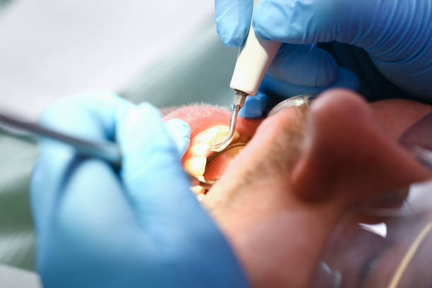 Best Emergency Root Canal Treatment in Unadilla, GA
